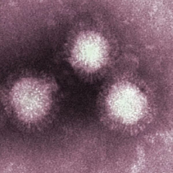 Syncytial virus. Респираторно-синцитиальная инфекция. Респираторно-синцитиальный вирус культивирование. Вирус краснухи под микроскопом. Возбудитель краснухи под микроскопом.