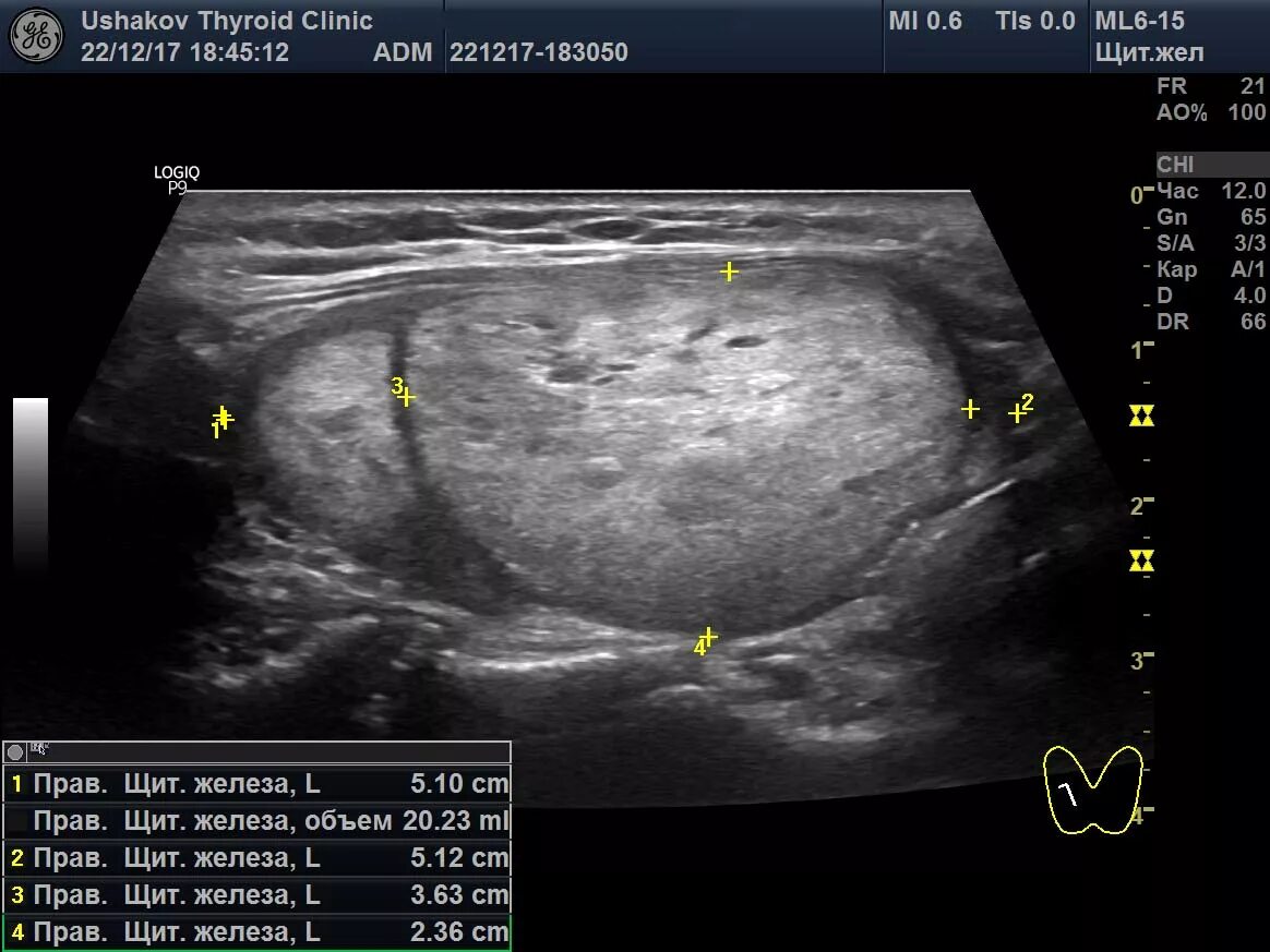 Ti rads что это значит. Классификация тирадс щитовидной железы УЗИ. Щитовидная железа УЗИ ti-rads. Ti-rads 5 УЗИ. Тирадс классификация узлов щитовидной железы.