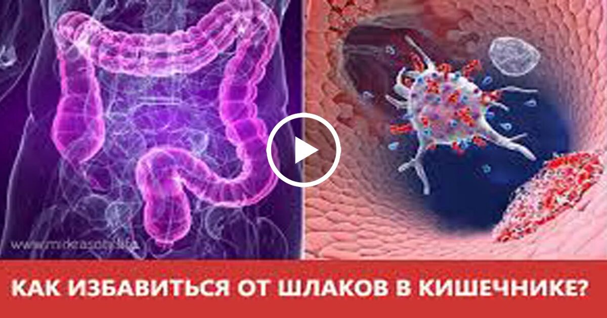 Как избавиться от камней в кишечнике