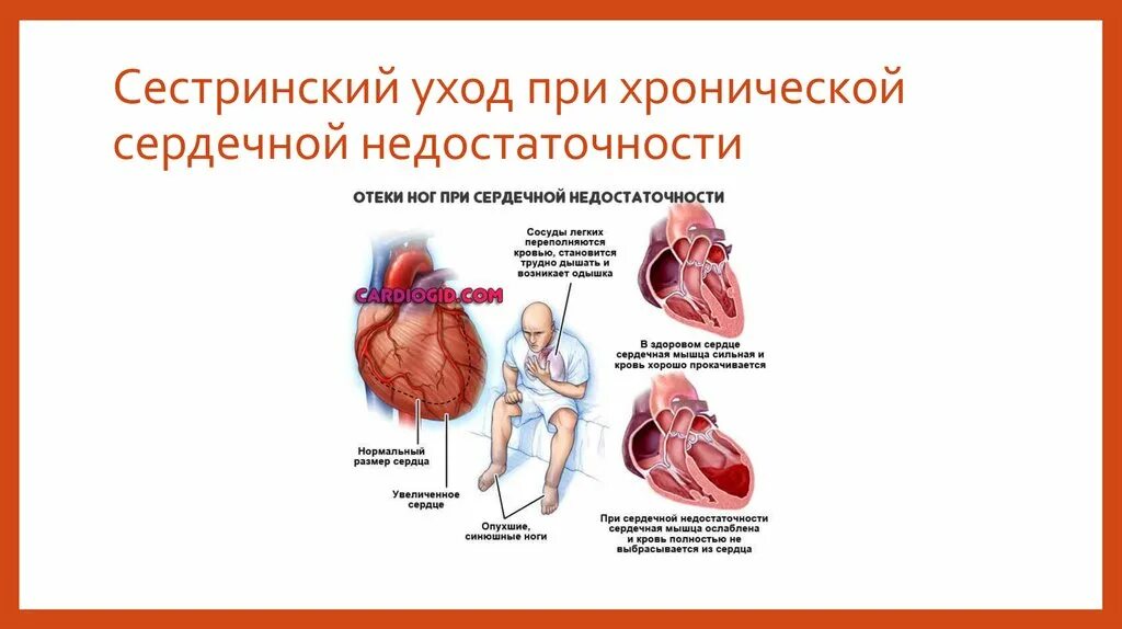 Белок сердечной недостаточности. Сестринский процесс при сердечной недостаточности. Хроническая сердечная недостаточность сестринский уход. Сестринский процесс хронической сердечной недостаточности. Сестринский процесс при заболеваниях ССС.