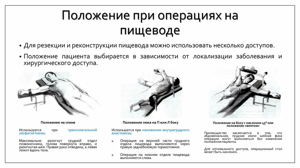 Положение больного на столе. Положение пациента на операционном столе. Положение пациента при операции. Положение пациента на операционном столе при различных операциях. Активное положение больного.