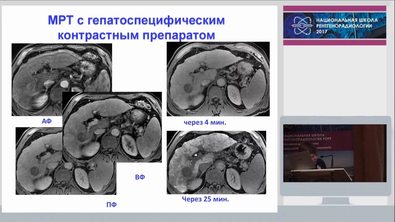 Нодулярная гиперплазия печени. Фокальная Узловая гиперплазия печени кт. Гиперденсивное образование печени на кт. Очаговая Узловая гиперплазия печени кт.