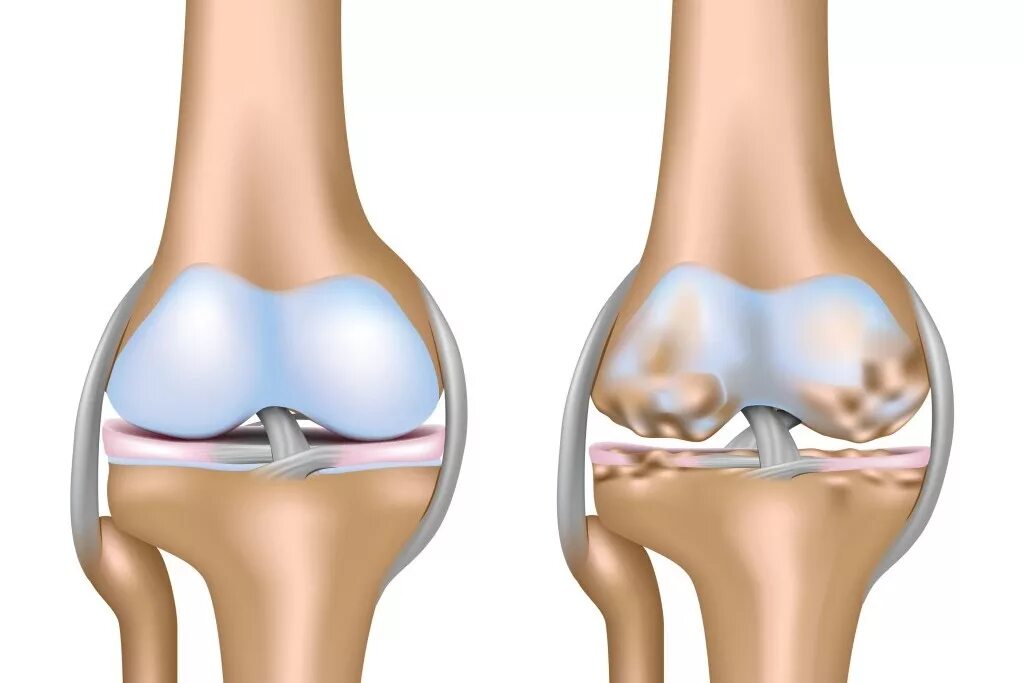 Остеоартрит коленного сустава. Разрушение коленного сустава. Гидрартроз коленного сустава. Что разрушает суставы