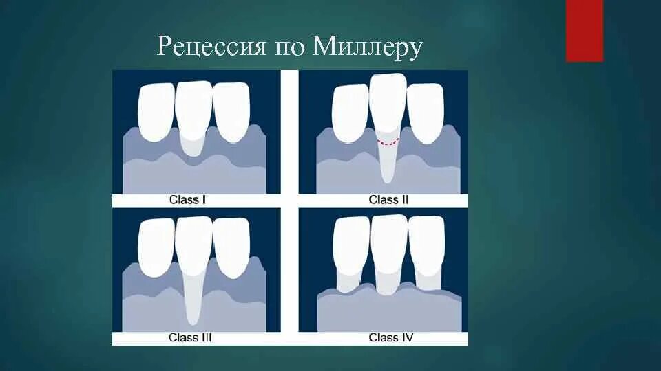 Индекс десна. Классификация Миллера рецессии десны. Классификация Miller рецессия десны. Рецессия классификация Миллера. Рецессия десны 1 класса по Миллеру.