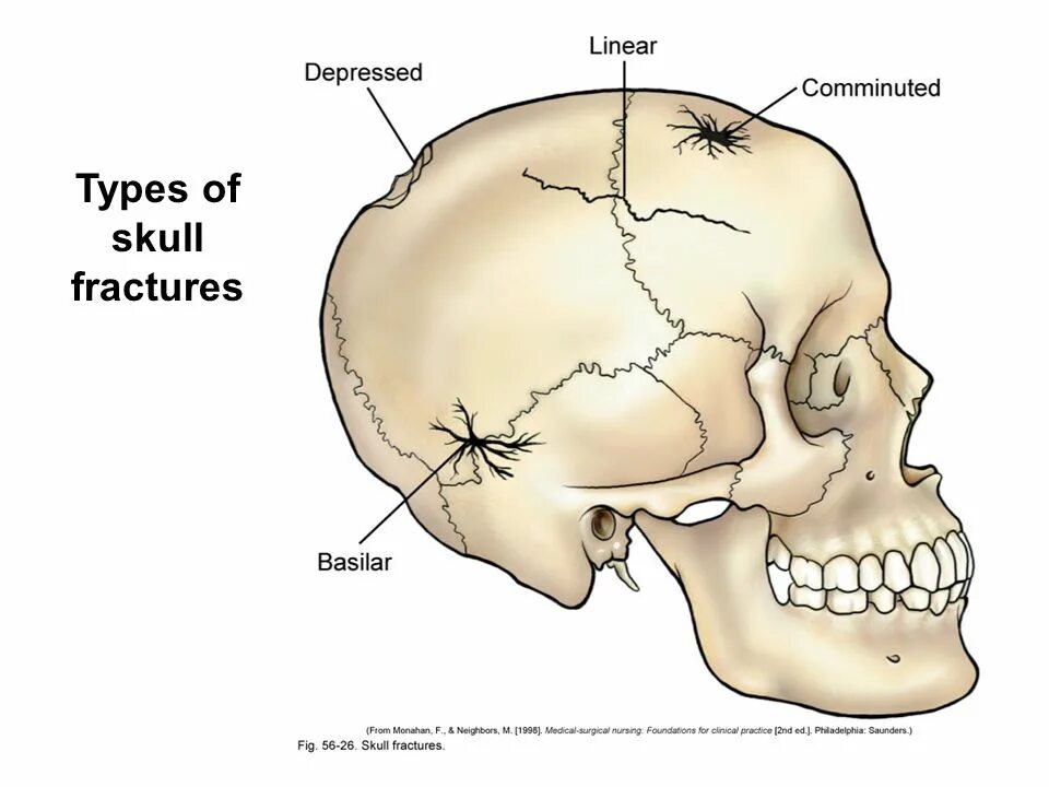 Трещина в голове. Морской череп кости.
