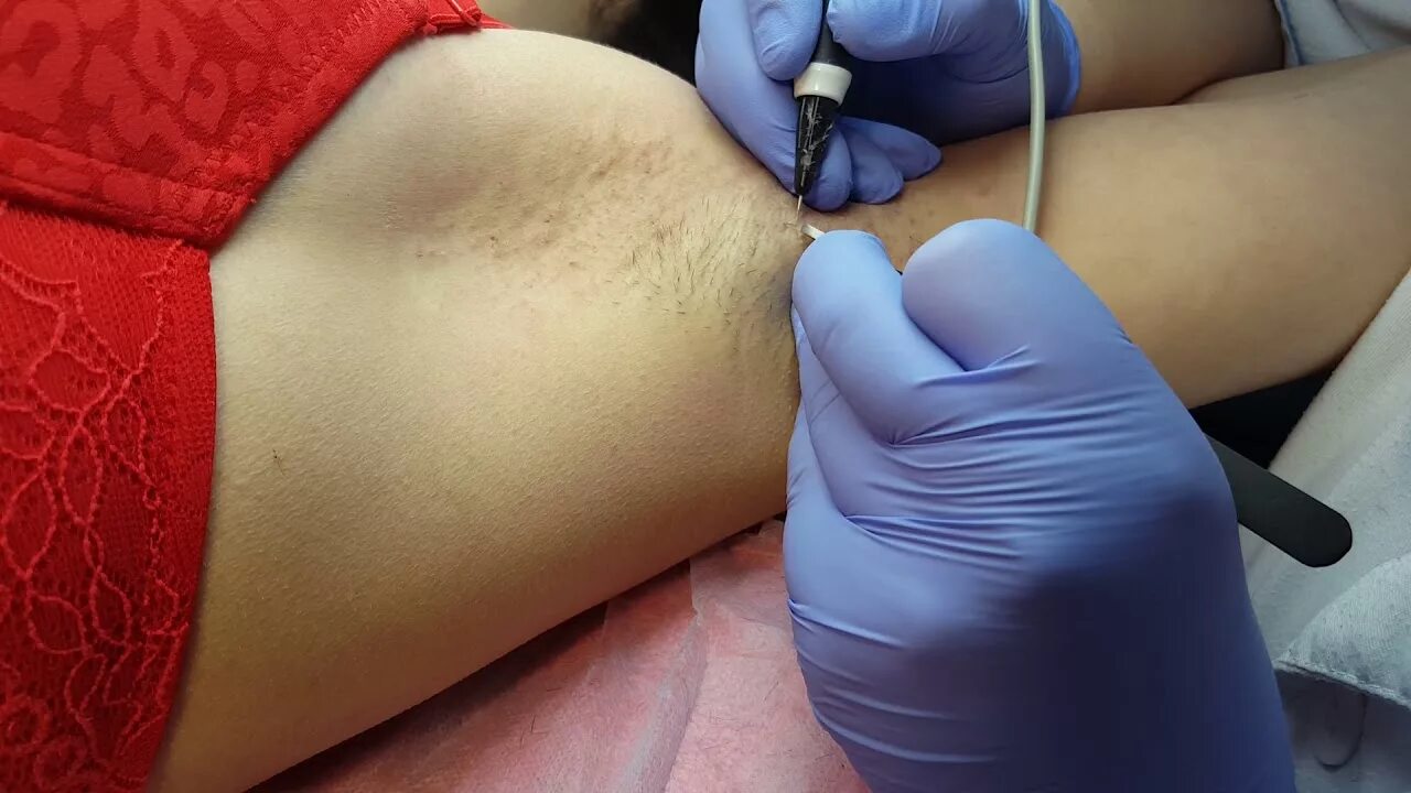 Как делают лазерную эпиляцию видео