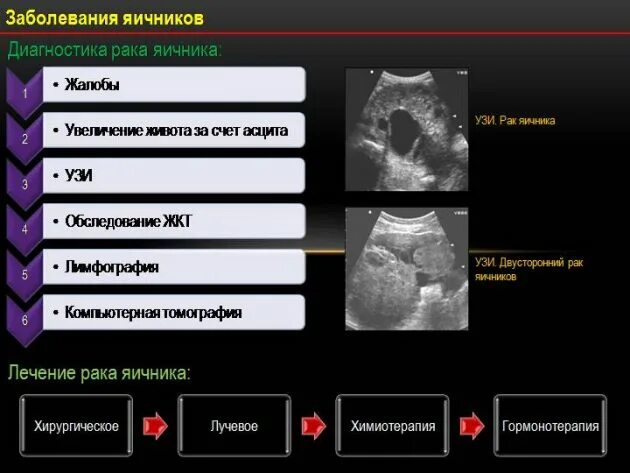 Методы диагностики опухолей яичников. Диагноз УЗИ новообразование яичника. Злокачественные опухоли яичников диагностика.