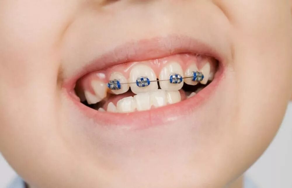 Зубы у подростков. Частичная брекет-система 2x4. Частичная брекет система 2 на 4.