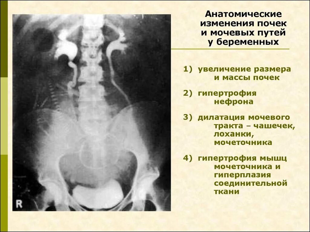 Дилатация мочеточника. Изменения почек при беременности. Мочеточники при беременности. Мочевыделительная система при беременности изменения. Изменения в мочевыделительной при беременности.