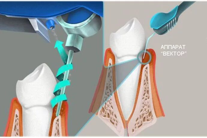 Vector пародонтологический аппарат. система вектор в стоматологии. вектор пародонтология. пародонтологический аппарат vector paro. Vector пародонтологический аппарат.