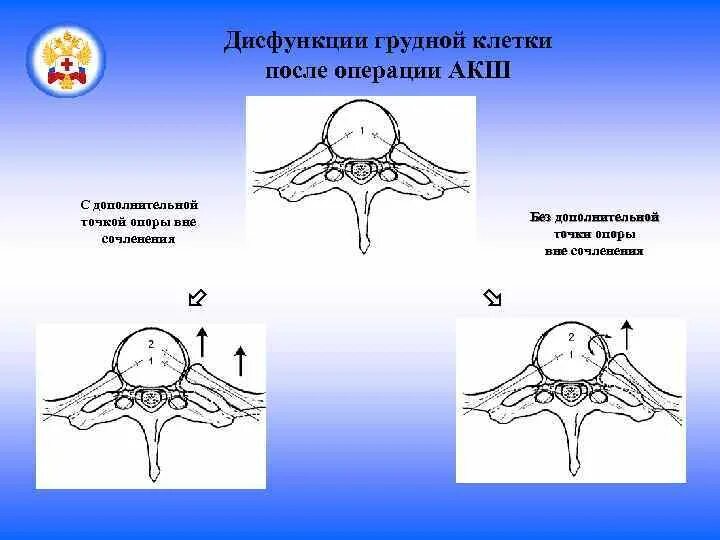 Грудная клетка после АКШ. Соединение грудины после шунтирования. Нарушение функции грудной клетки. Несращивание грудины после АКШ.