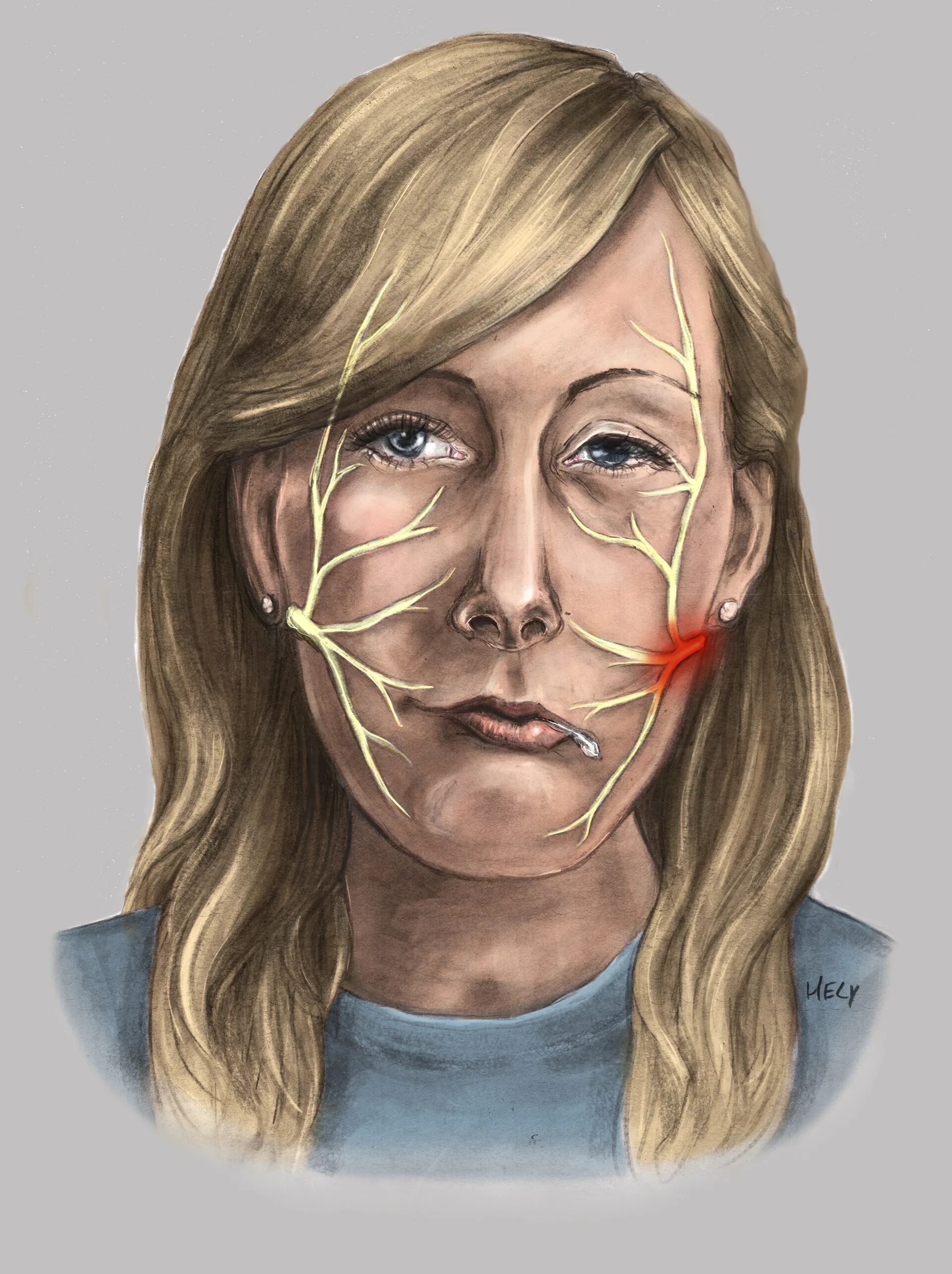 Тройничный нерв на лице. Гипестезия тройничного нерва. Неврит тройничного нерва. Ганглионит узла коленца лицевого нерва.