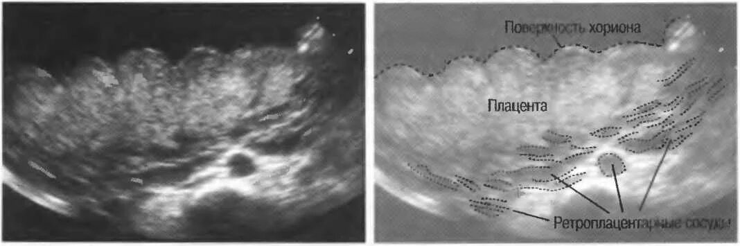 Отслойка хориона на ранних сроках. Субамниотическая отслойка плаценты. Эхография отслойки плаценты. Ретроплацентарной гематомы. Преждевременная отслойка плаценты УЗИ.