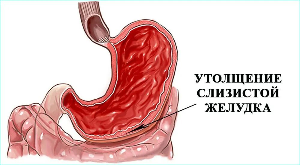 Острый катаральный гастрит. Поверхностный бульбит и дуоденит. Язва желудка поверхностный бульбит. Хронический гипертрофический гастрит. Слизистой оболочки желудка признаки