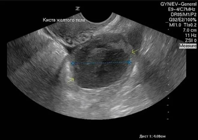Образование округлое в яичнике. Геморрагическая киста яичника на УЗИ. Киста желтого тела яичников. Фолликулярная киста желтого тела. Киста желтого тела левого яичника с кровотоком.