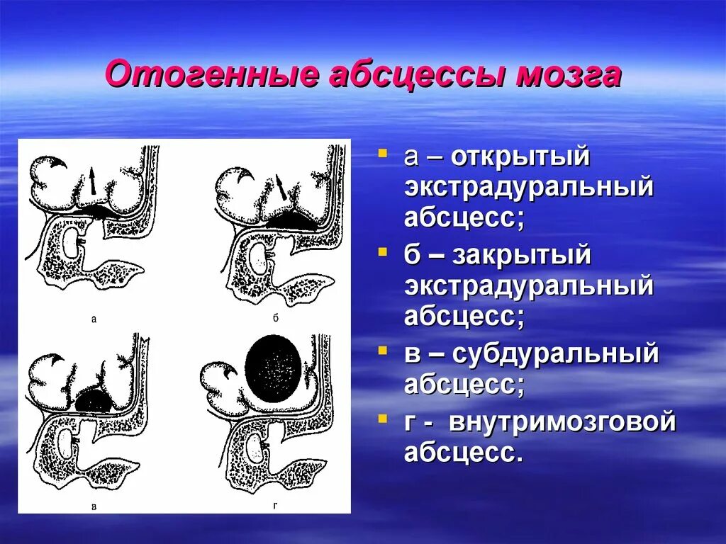 Отогенные осложнения. Отогенный абсцесс мозга. Отогенный экстрадуральный абсцесс. Субдуральный отогенный абсцесс. Отогенные внутричерепные осложнения.