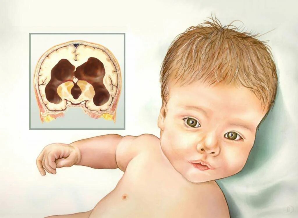 Нарушение развития головного мозга. Гидроцефалия головного мозга у ребенка. Внутренняя гидроцефалия головного мозга у грудничка. Гидроцефалия головного мозга синдромы у ребенка. Гидроцефалия врождённая у плода.