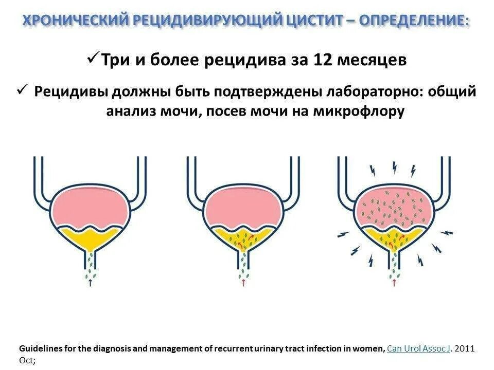 Жжение в головке после мочеиспускания. Проявление цистита. Женский цистит. Цистит причины симптомы. Лёгкая форма цистита у женщин.