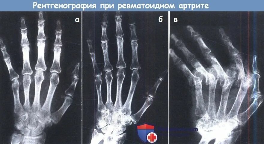 Артрит суставов стадии. Ревматоидный артрит кисти рентген. ревматоидный артрит 2 стадии рентген. кисть ревматоидный артрит узи. ревматоидный артрит кистей на рентгенограмме.