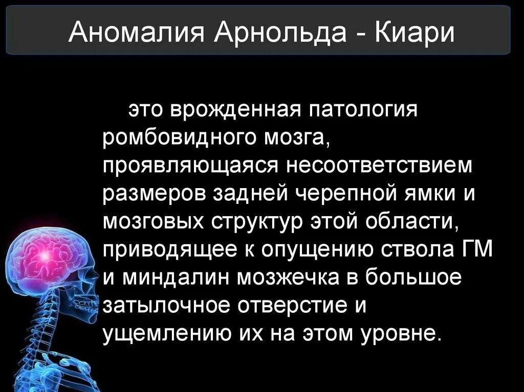 Аномалия Арнольда Киари на кт. Аномалия Арнольда-Киари 1 типа.