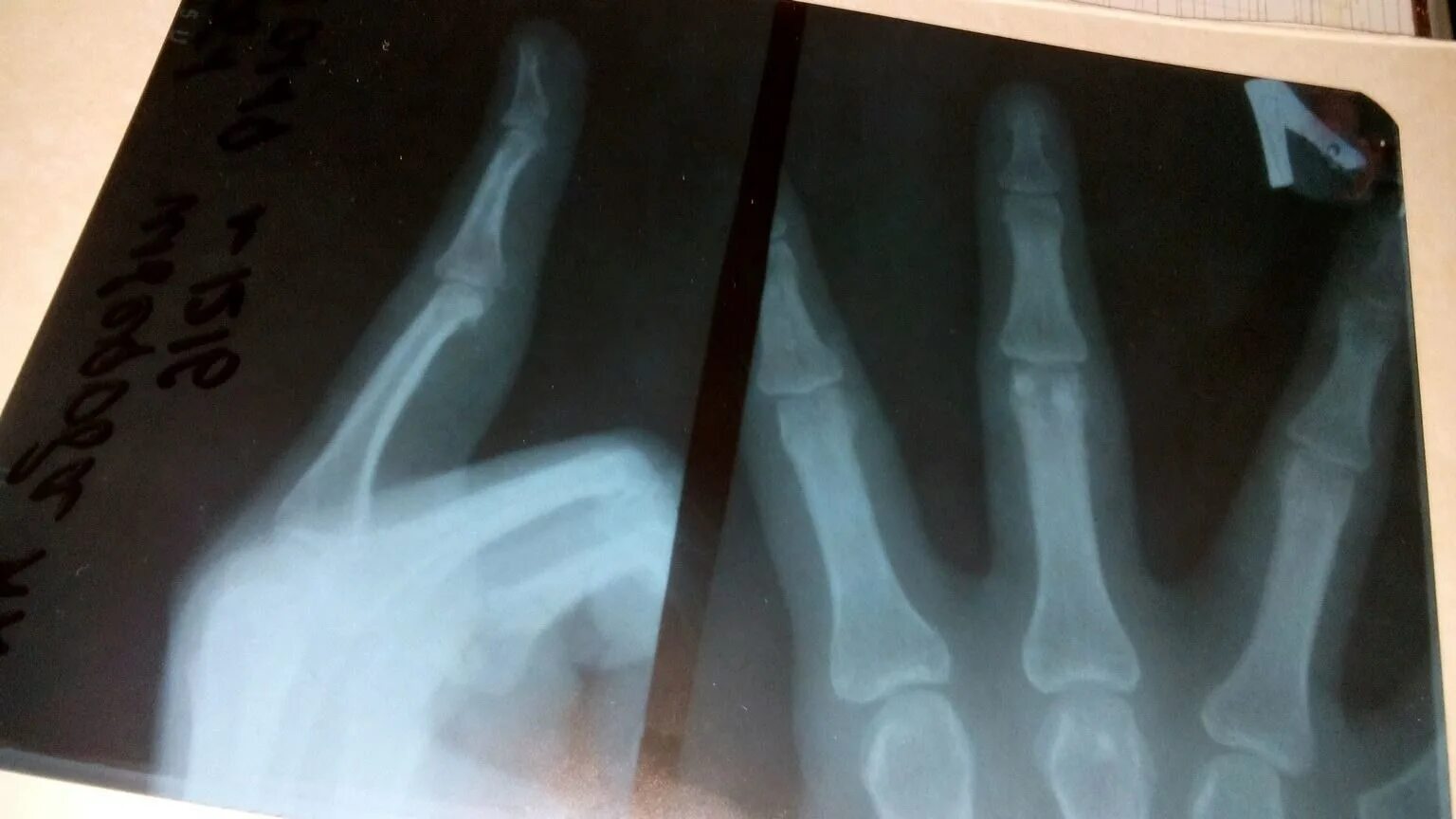 Снимок сломанной руки рентген. Перелом третьей степени.