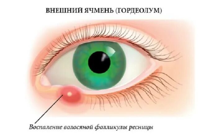 Чем лечится ячмень. Воспаление мейбомиевой железы глаза.