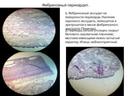 Фибринозный перикардит микропрепарат