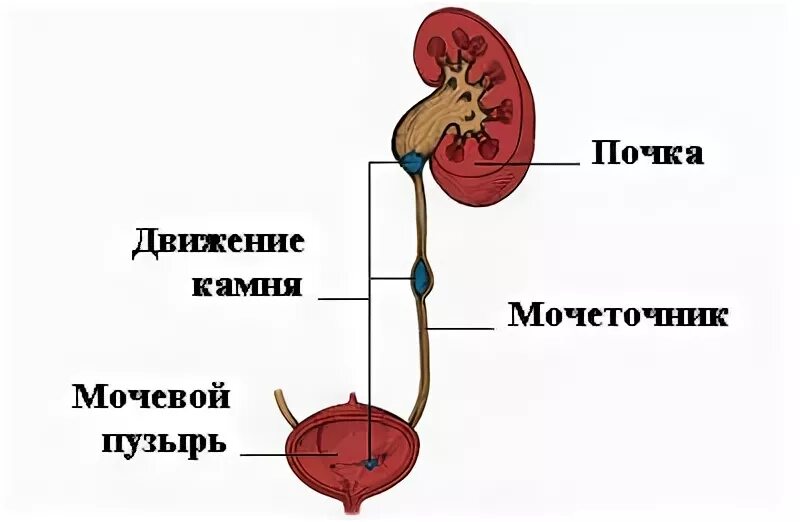 Вышел камень из мочеточника у мужчин. Камни в мочеточниках схема. Мочеточники и мочевой пузырь анатомия. Камень в мочеточнике у мужчин схема. Камень в Устье мочеточника 5 мм.