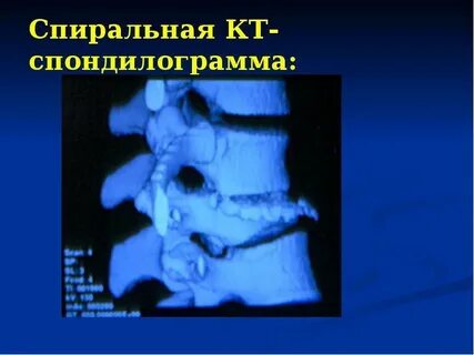 Спондилография