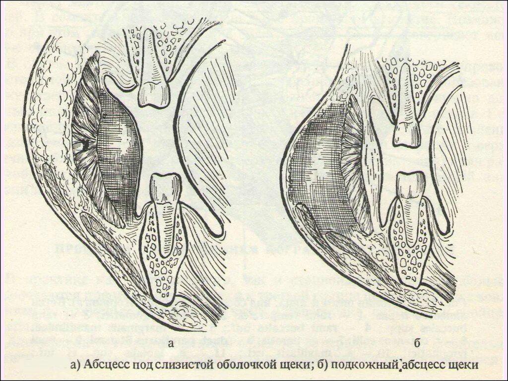 Периодонтальный абсцесс. Парафасциальный абсцесс. Пародонтический абсцесс.