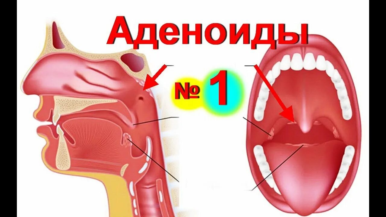 Аденоиды носоглоточные миндалины. Аденоидные вегетации 1