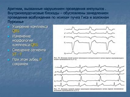 Нижняя стенка желудочка нарушение проводимости