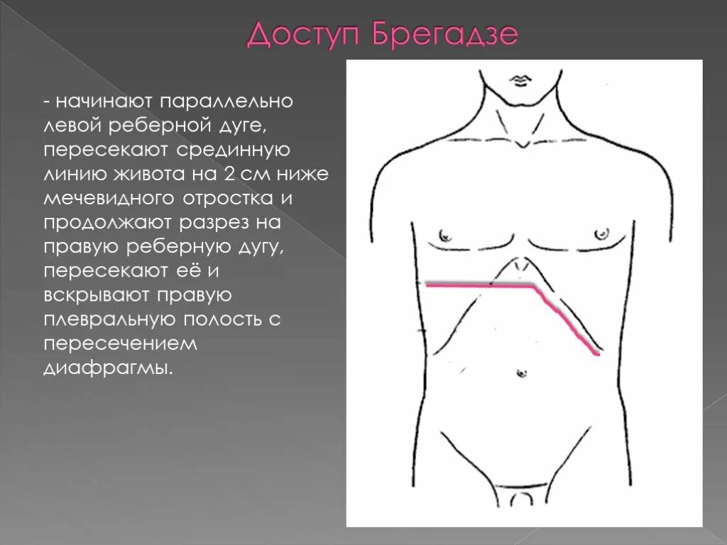 Печень ниже реберной дуги. Разрез по Рио Бранко. Доступы кохера, Курвуазье, Федорова. Разрез Федорова лапаротомия. Лапаротомия Рио Бранко.