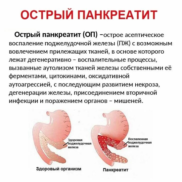 Особенности панкреатита. Болезнь поджелудочной железы панкреатит. Симптомы проявления острого панкреатита. Острый панкреатит основные синдромы. Панкреатин поджелудочная железа.