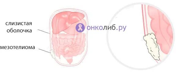 Доброкачественная мезотелиома кт. Диффузная мезотелиома. Мезотелиома плевры брюшины и других локализаций. Эпителиоидная мезотелиома плевры. Мезотелиома плевры кт картина.