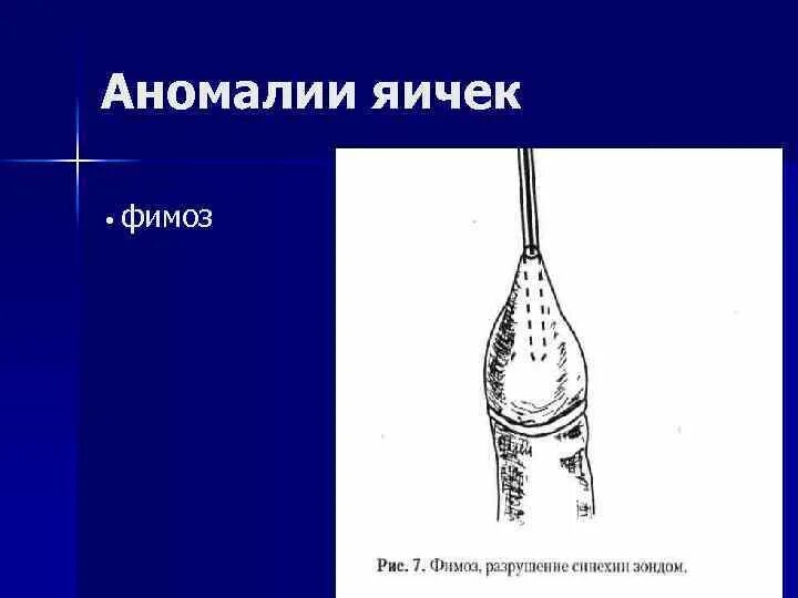 Фимоз у детей что это. Фимоз у детей что это