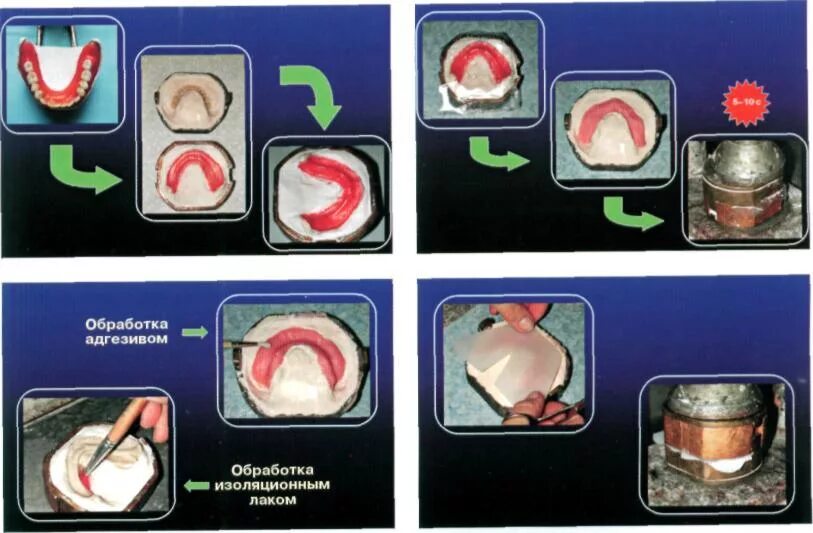 Клинико лабораторные этапы съемных пластиночных протезов. Технология изготовления протеза с двухслойным базисом. Гипсовка восковой композиции протеза в кювету. Гипсовка протеза в кювету. Технология двухслойных базисов.