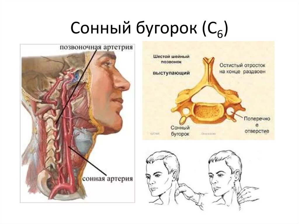 Сонная артерия где находится как нащупать. Сонный бугорок шейного позвонка. Сонный бугорок vi шейного позвонка - tuberculum caroticum. 6 Шейный позвонок анатомия Сонный бугорок. Сонная артерия на 6 позвонке.