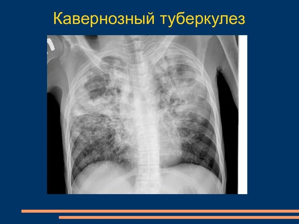 Заболевания грудной полости. Заболеваний органов грудной полости. Лучевая анатомия органов грудной полости. Лучевые признаки заболеваний органов дыхания лучевая диагностика. Диагностика поражений органов грудной клетки.