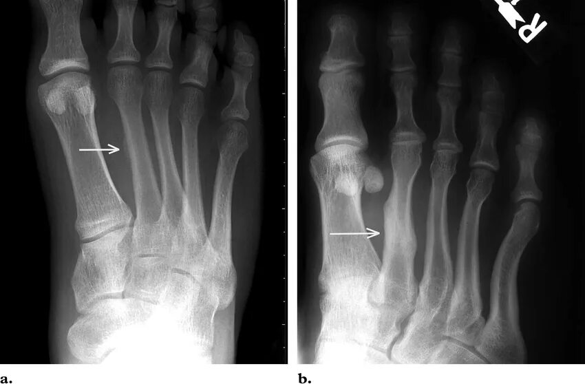 Трещина плюсневой кости. Перелом 2-3 плюсневой кости. Перелом плюсневой кости 2 3 4. Маршевый перелом 3 плюсневой кости. Субкапитальный перелом 4 плюсневой кости.