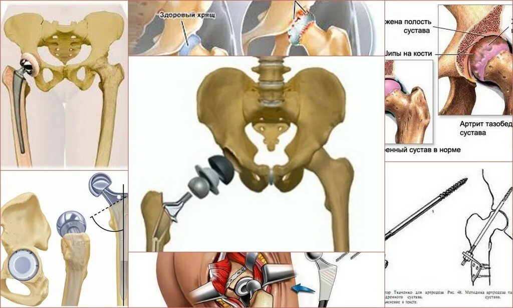 Операция по замене тазобедренного как происходит. Тазобедренный сустав анатомия коксартроз. Коксартроз 3 степени коксартроз тазобедренного сустава. Коксартроз 3 степени операция. ТБС тазобедренного сустава.