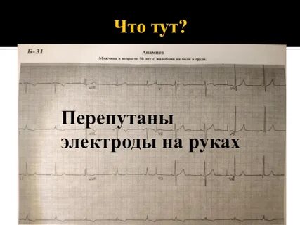 Перепутанные электроды