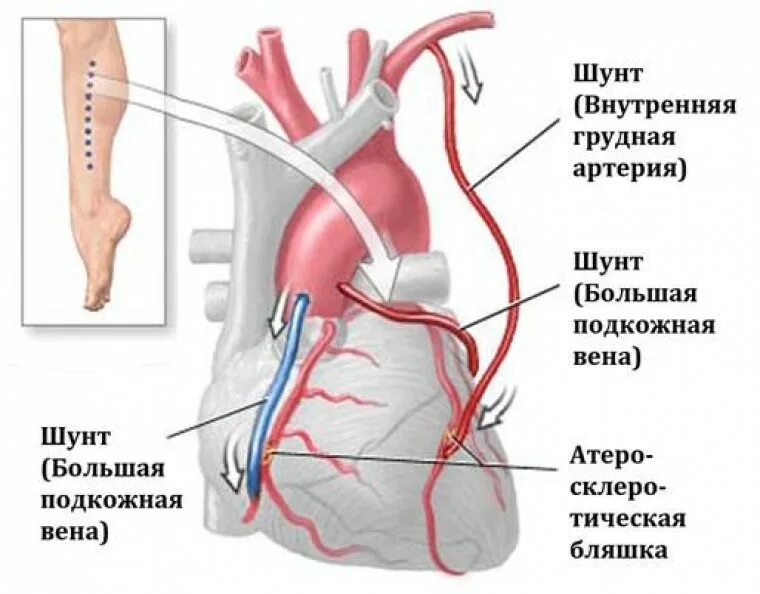 После операции коронарного шунтирования. Аортокоронарное шунтирование схема операции. Коронарное шунтирование сосудов сердца. Коронарное шунтирование схема. Аутовенозное коронарное шунтирование.