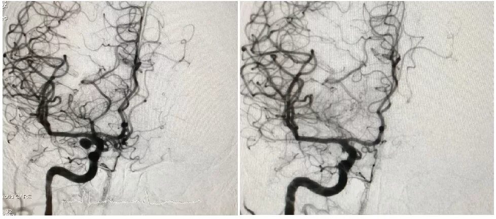 Аневризма головного мозга эндоваскулярным. Эндоваскулярная окклюзия аневризм сосудов головного мозга. Эмболизация артерий головного мозга. Эндоваскулярная эмболизация аневризм сосудов головного мозга.. Аневризма головного мозга стентирование.