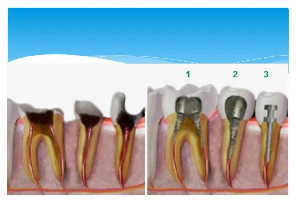 культевая вкладка и коронка схема. коронка на штифте в корень. штифитовао культеваявкладка. штифтовые зубы и штифтовые конструкции. коронка на штифте в корень.