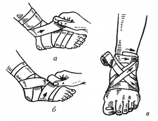 Восьмиобразная повязка на голеностопный сустав техника. Наложить восьмиобразную повязку на голеностопный сустав.. Повязка на голеностопный сустав восьмиобразная техника наложения. Наложение 8-образной повязки на голеностопный сустав. Какая повязка при повреждении голеностопного сустава