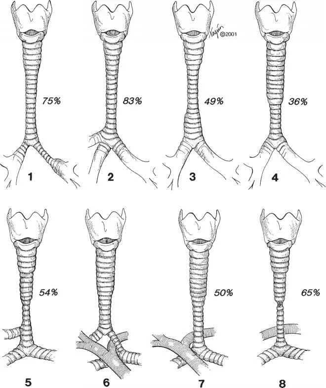 Спадение бронха