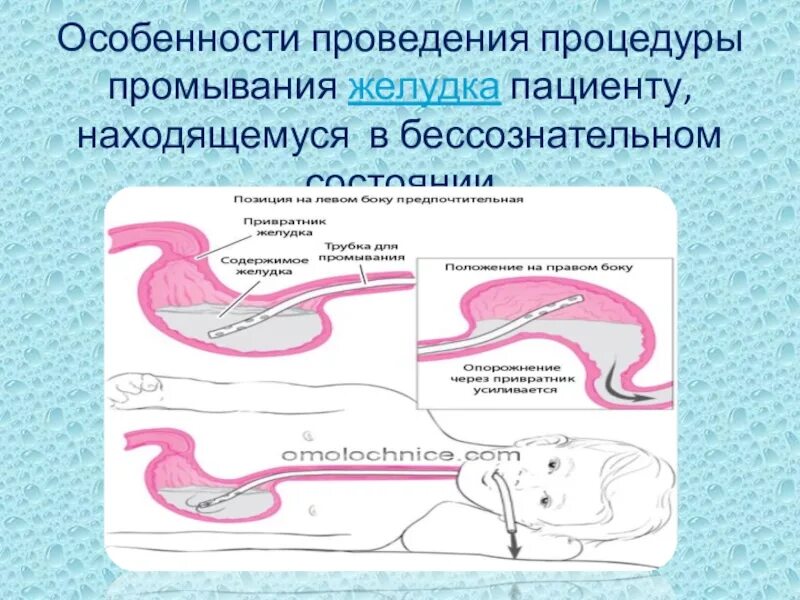 Зондовые манипуляции. Промывание желудка без сознания алгоритм. Промывание желудка пациенту в бессознательном состоянии. Пациенту без сознания промывание желудка. Промывание желудка в сознании и без сознания.