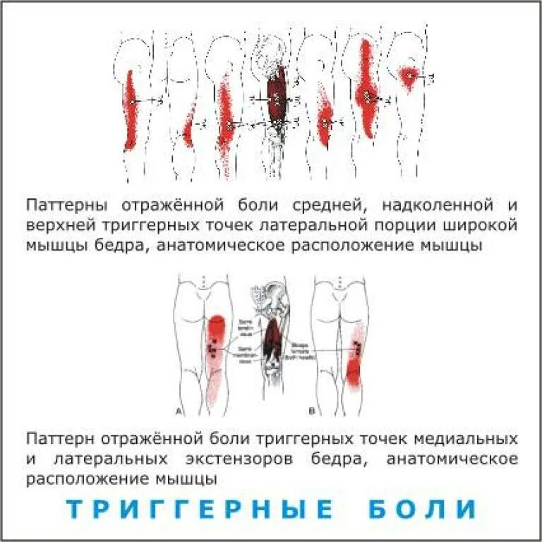 Болит бедро и поясница. Триггеры мышц задней поверхности бедра. Триггерные точки бедра. Триггерные точки мышц бедра. Триггерные точки мышц ног.