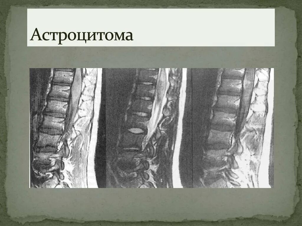 Эпендимома спинного. Образование позвоночника. Астроцитомы спинного мозга. Гиподенсное образование в позвоночнике что это такое. Очаговые образования позвонков.